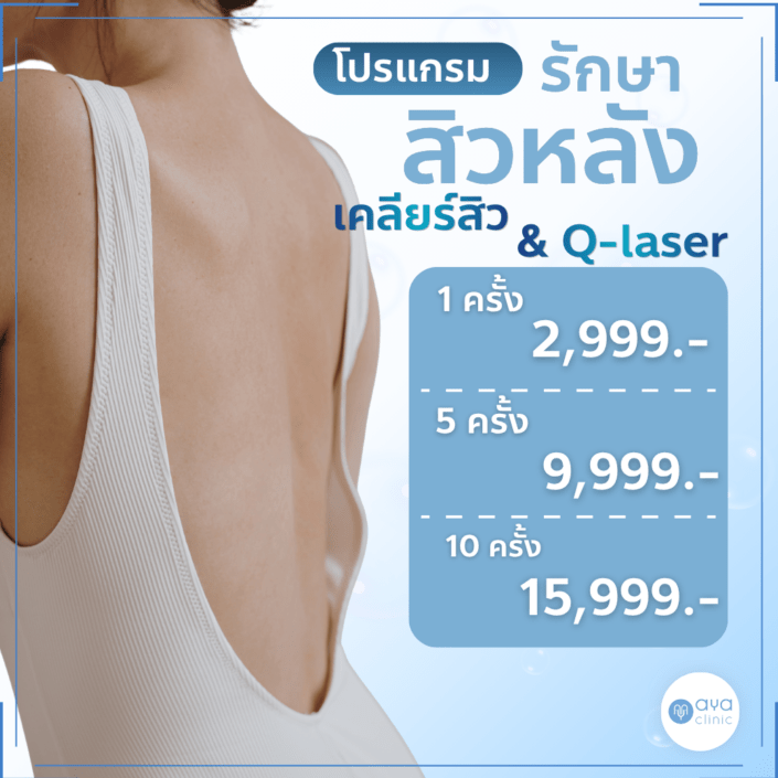 รักษาสิวหลังลดรอยดำด้วยเลเซอร์
