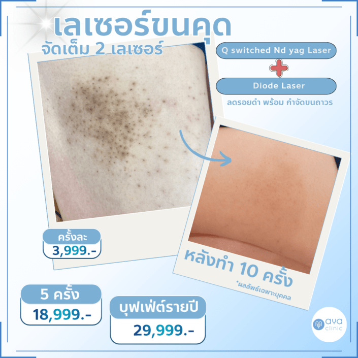 เลเซอร์กำจัดขนคุด