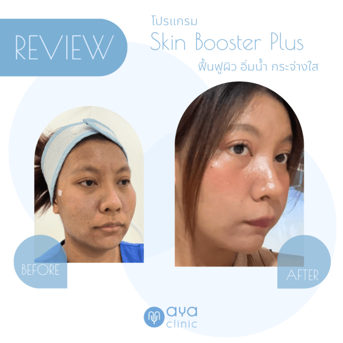 Skin booster ผิวอิ่มน้ำ