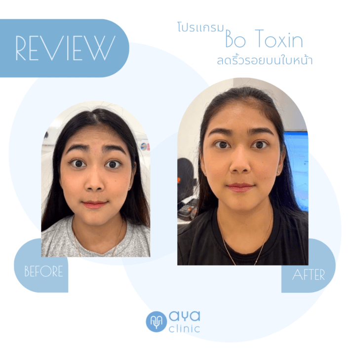 Botox ลดริ้วรอยหน้าผาก