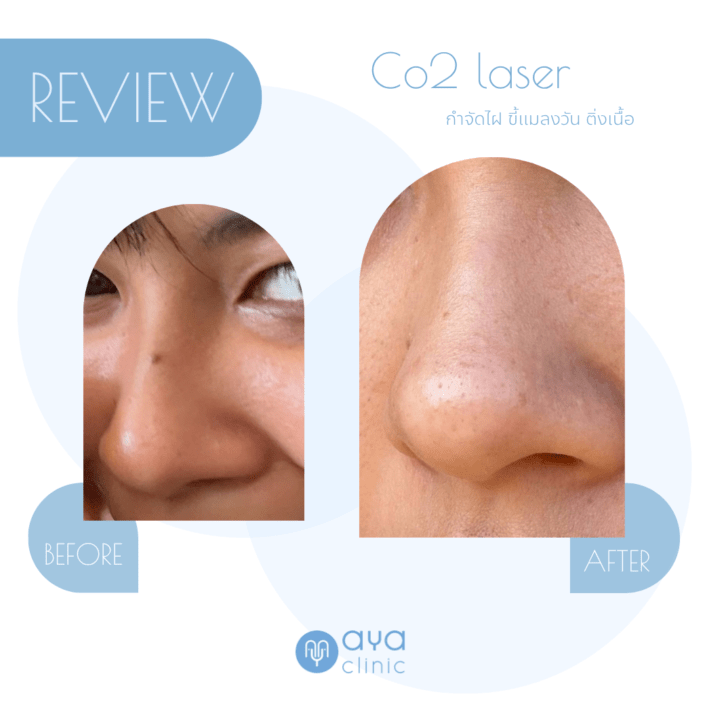 Co2 Laser กำจัดขี้แมลงวัน