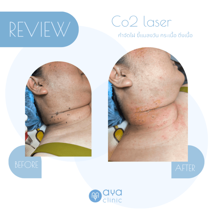 Co2 Laser กำจัดติ่งเนื้อที่คอ