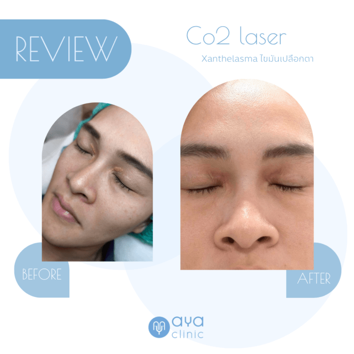 Co2 Laser กำจัดไขมันเปลือกตา