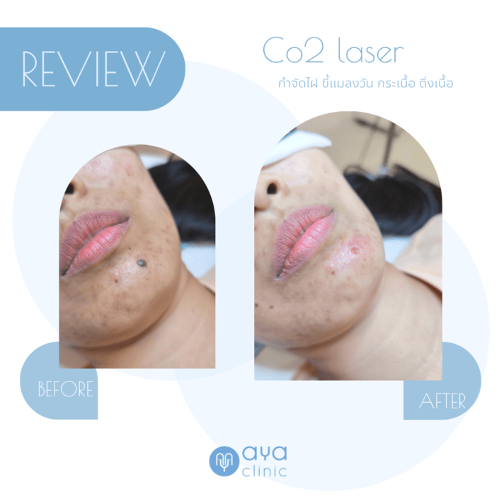 Co2 Laser กำจัดไฝ