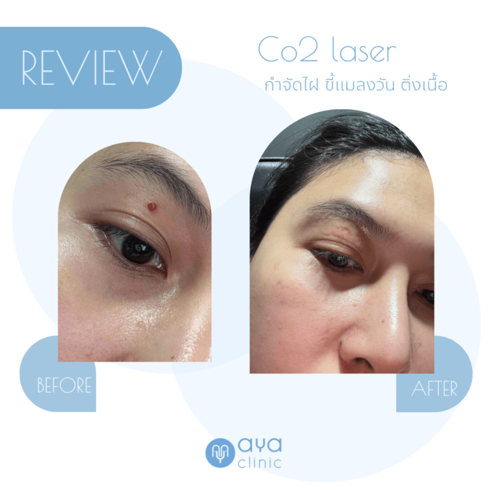 Co2 Laser กำจัดไฝแดง