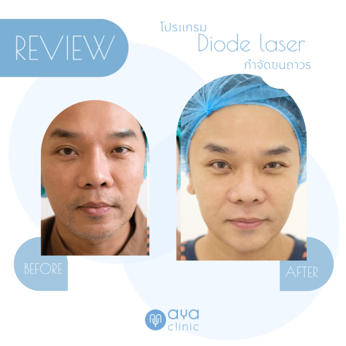 Diode Laser กำจัดหนวด เครา
