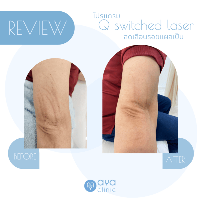 Qswitch Laser ลดเลือนรอยแผล