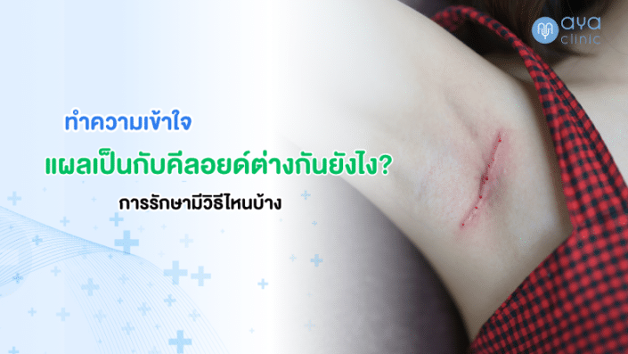 ทำความเข้าใจแผลเป็นกับคีลอยด์